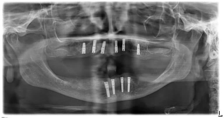 Chirurgicko-protetické ošetření atrofované čelisti implantáty BioniQ S2.9